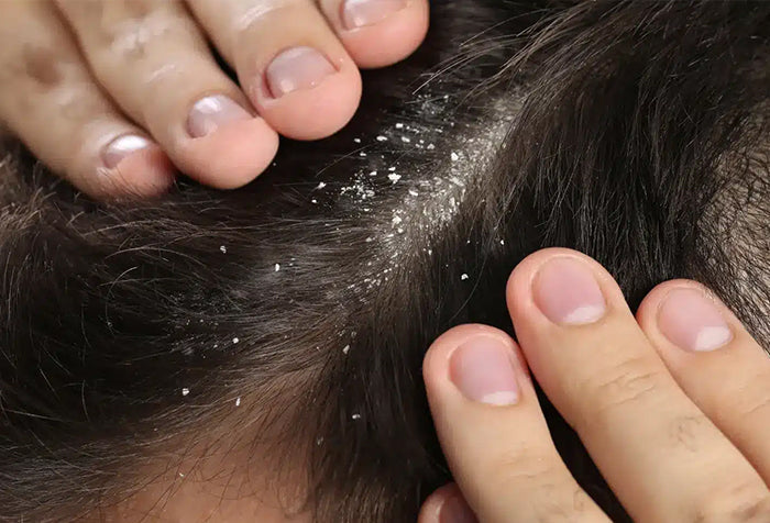 Close-up of fingers parting dark hair to reveal a scalp with visible dandruff flakes.