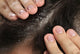 Close-up of fingers parting dark hair to reveal a scalp with visible dandruff flakes.
