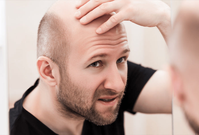 Balding man examining his head.