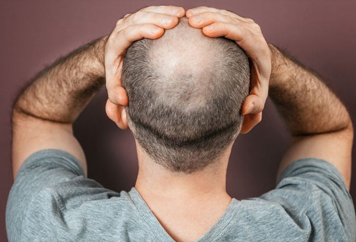 Stressed balding man holding his head.