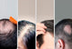 Images of different men's hair experiencing balding.