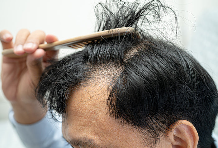 Balding man examining his hair line with a comb.