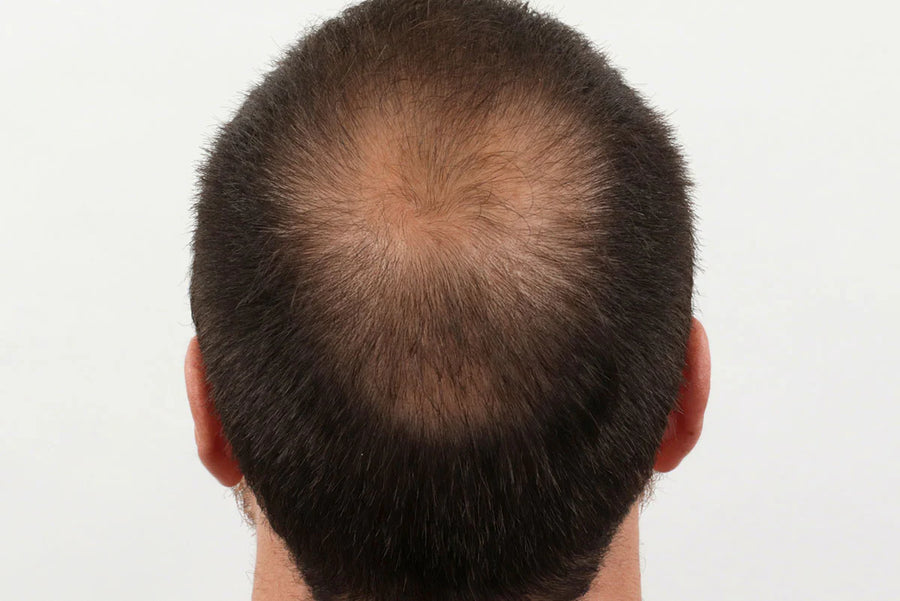 After photo — Men