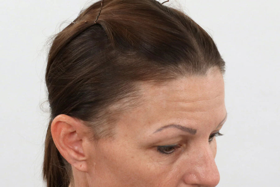 Before photo — Women